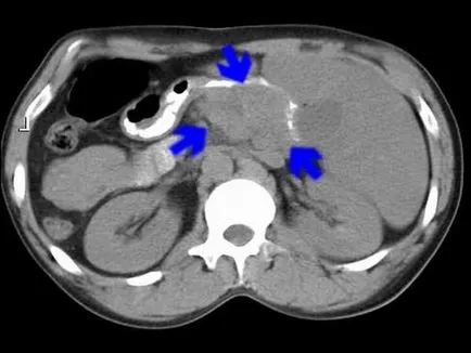 Pancreatitis pseudotumor okoz, tünetek és a kezelés jellemzői