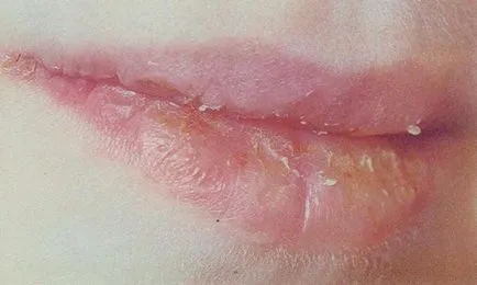 De ce se dezvolta buzele bolii și cum să le recunoască