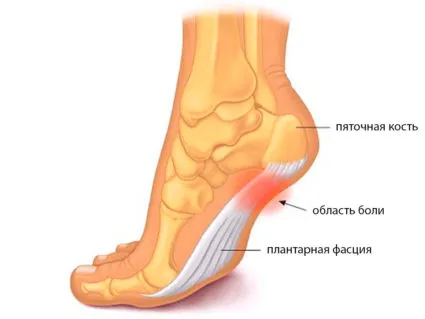 cauze și tratament Aponevrosa plantari