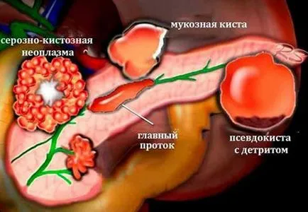 Полипите в панкреаса причини