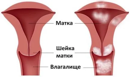 cervicale stare precanceroasă cauze, simptome, diagnostic, tratament