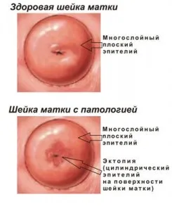 cauze pseudo cervicale și tratamentul bolii