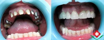 Protézis, korona hozott egy foga, és hogyan kell gondozni kivehető fogpótlások - fogászati ​​tippek