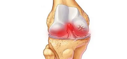 Megelőzése arthritis