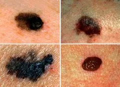 Bőrrák jeleit és tüneteit, a kezdeti szakaszban a hogyan teremthettek