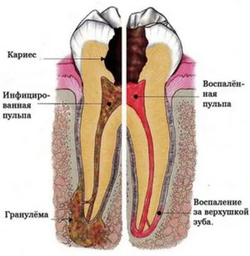 pulpa dentară este, simptome și tratament