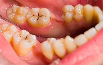Кореновата киста зъб - Симптоми и методи на лечение