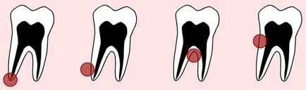 Radicularis ciszta tooth - tünetek és kezelési módszerek