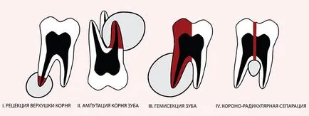 Кореновата киста зъб - Симптоми и методи на лечение