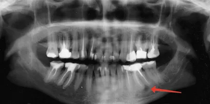 Radicularis ciszta tooth - tünetek és kezelési módszerek