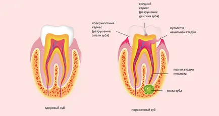 Radicularis ciszta tooth - tünetek és kezelési módszerek