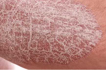 Psoriasis könyök tünetek fotó kezdeti szakaszban, kezelésére