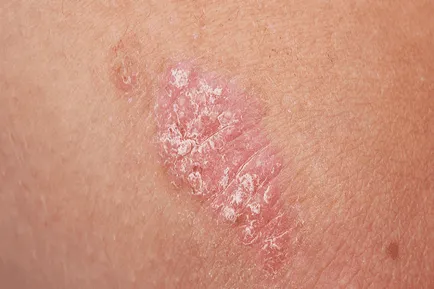 Psoriasis könyök tünetek fotó kezdeti szakaszban, kezelésére