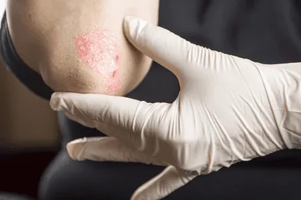 Psoriasis könyök tünetek fotó kezdeti szakaszban, kezelésére