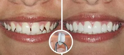 Възстановяване на избелване на зъбите - как да се извърши процедурата са плюсовете и минусите