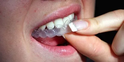 Възстановяване на избелване на зъбите - колко и колко ефективна процедура в клиниката