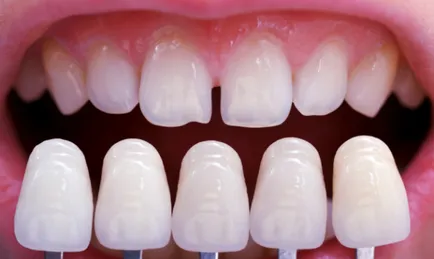 Възстановяване на избелване на зъбите - как да се извърши процедурата са плюсовете и минусите