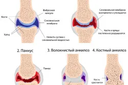 Ревматоиден артрит лечение и профилактика