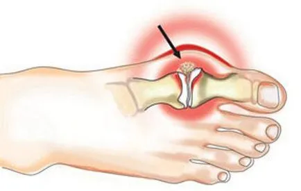 Ревматоидният артрит е популярна лечение