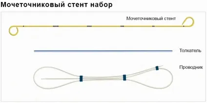Як вибрати якісні урологічні сечоводо стенти (урологічні) Як вибрати якісні урологічні сечоводо стенти