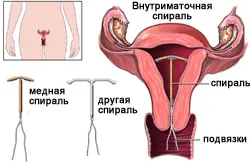 spirală intrauterine - comentarii și recomandări