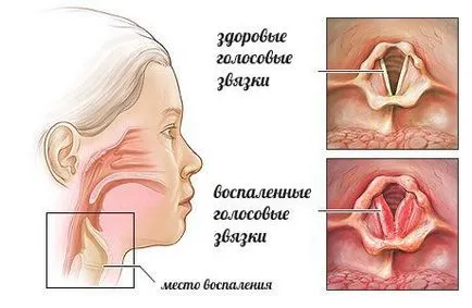 Stenoza a laringelui la copii simptome, cauze, tratament, prevenire, complicații