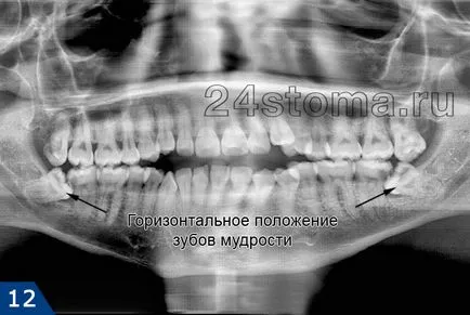 Extracție dentară este să știi despre operațiunea