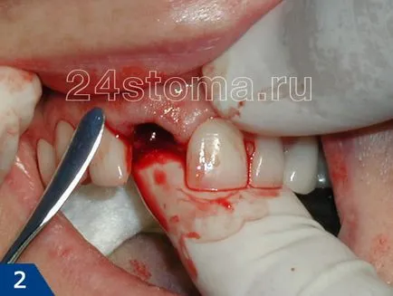 Extracție dentară este să știi despre operațiunea