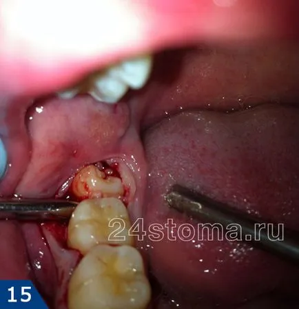 Extracție dentară este să știi despre operațiunea