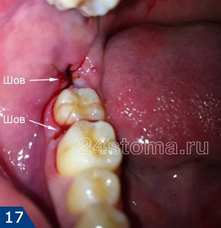 Extracție dentară este să știi despre operațiunea