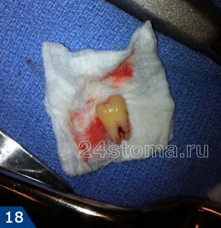 Extracție dentară este să știi despre operațiunea