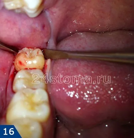 Extracție dentară este să știi despre operațiunea