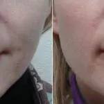 Ajakfeltöltés Botox lehetséges következményeit az eljárás