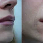 Lip увеличаване Ботокс възможни последствия от процедурата