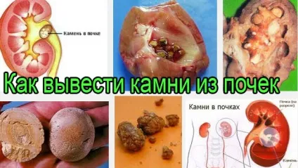 Як вивести камені з нирок - дієві методи, лікування в домашніх умовах