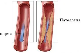 Venoase disgemiya creier, în plexul vertebrale, cauze, diagnostic, simptome,