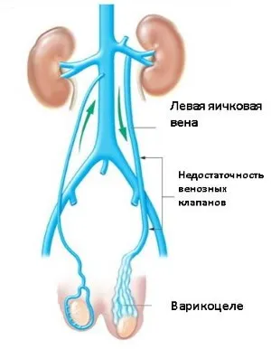 Varicocele - tünetek, okok, mértékét és kezelési eljárások az varicocele