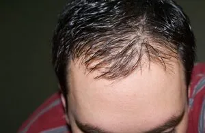 hajátültetés után alopecia technikák