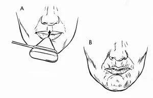 Proboscis reflex csecsemők, gyermekek és felnőttek diagnózis és célok