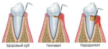 Оперативно лечение на периодонтити съвременни методи и етапи на лечение, хирургия или здравословен