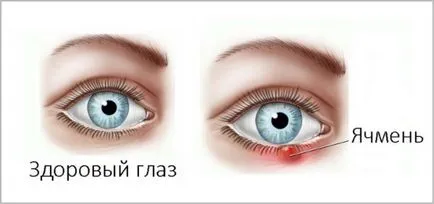 Ечемик на окото - какво да правя у дома, отколкото лечение