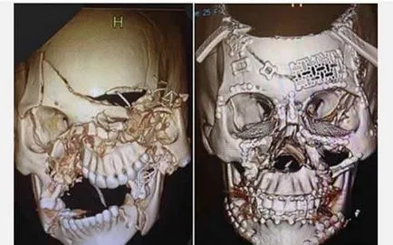 A sebész bebizonyította, hogy fontos a biztonsági övek, megállapító egy X-ray a koponya a baleset után