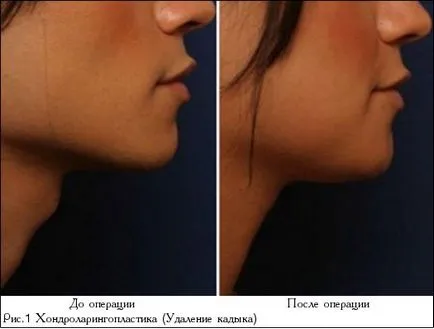 Chondrolaryngoplasty - ádámcsutkája eltávolítása és hang elnőiesedése