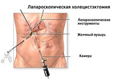 Viața după îndepărtarea vezicii biliare sfaturi importante și trucuri