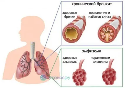 Кашель у дитини 3 роки ніж лікувати, сильний вночі, сухий, комаровский, нападоподібний, що робити (сухий) Кашель у дитини 3 роки ніж лікувати, сильний вночі, сухий, комаровский, нападоподібний, що робити