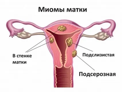 Картопляний сік при міомі матки (відгуки) (картопляний) Картопляний сік при міомі матки (відгуки)
