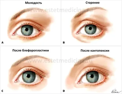 Кантопексія століття (верхніх і нижніх) рекомендації експерта, інтернет-журнал