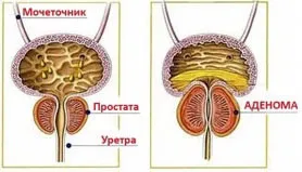 HBP - simptome, tratament, simptome, o intervenție chirurgicală