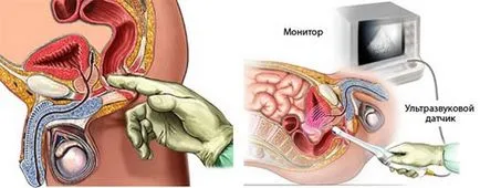 HBP - simptome, tratament, simptome, o intervenție chirurgicală