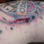 Алергии към Tattoo (татуировка боя) какво да правя